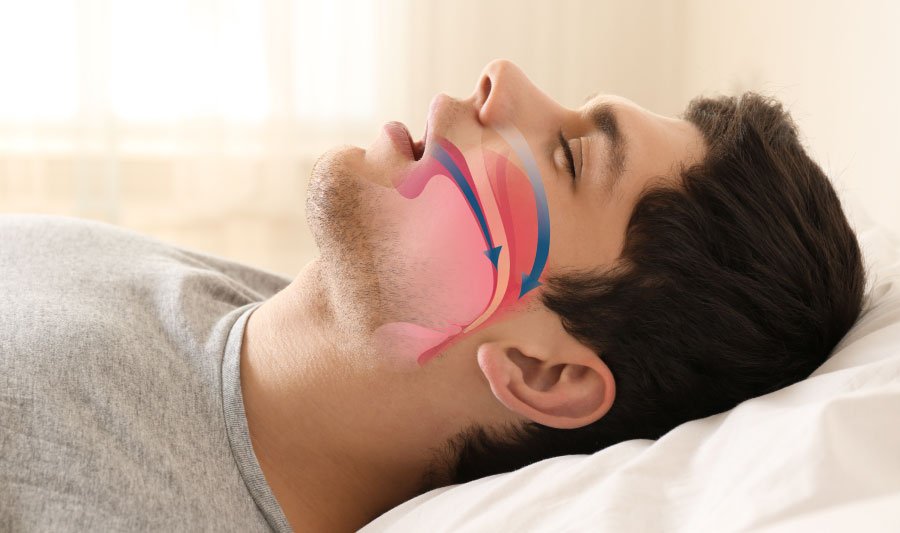 Snoring Treatment  Bellingham and Snohomish