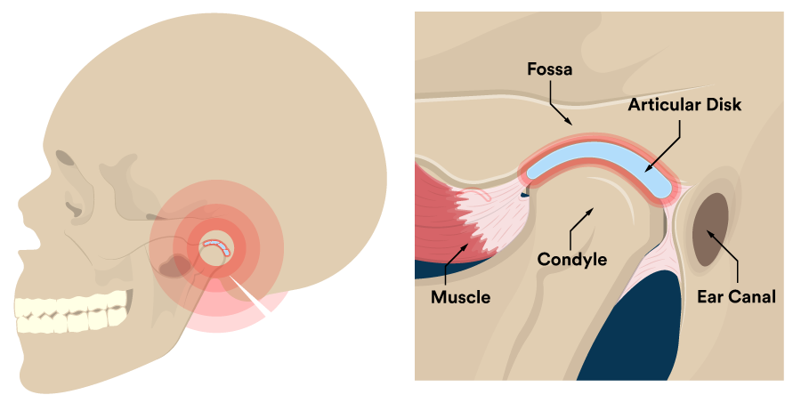 TMJ Disorders Treatment Bellingham and Snohomish